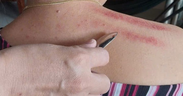 Cạo gió và những sai lầm cần tránh 1 14 chot 1732368550017421499126 456 0 906 720 crop 1732370549895630328405