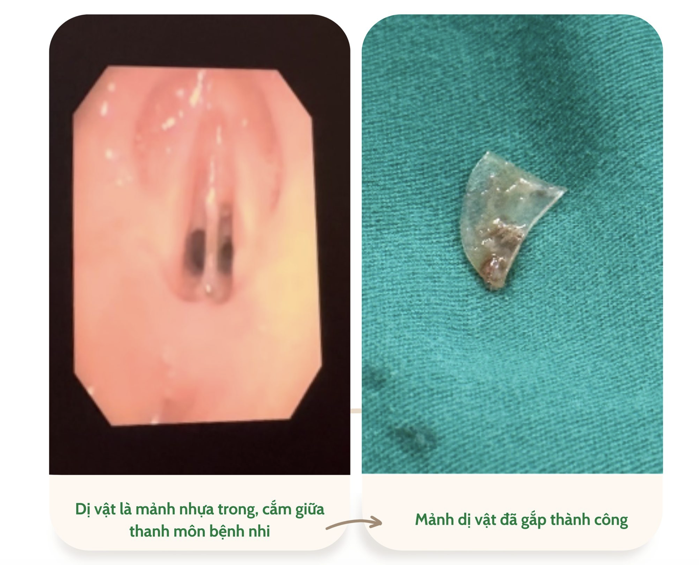 Bé gái bị dị vật bỏ quên nơi hiếm gặp- Ảnh 1. Bé gái bị dị vật bỏ quên nơi hiếm gặp- Ảnh 1.