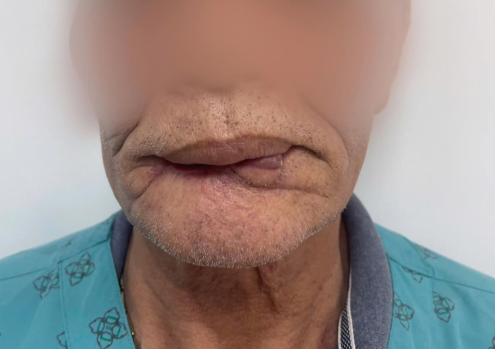 Người đàn ông bị chó cắn đứt rời môi- Ảnh 1. Người đàn ông bị chó cắn đứt rời môi- Ảnh 1.